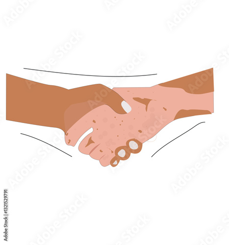Hands with dermatological disease vitiligo.