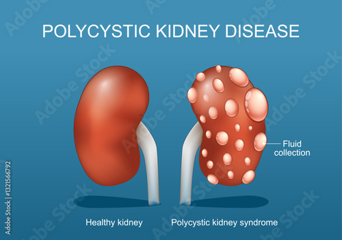 Polycystic kidney disease