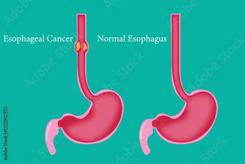 Medical illustration of esophageal cancer vs. normal esophagus.