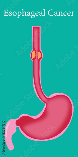 Esophageal cancer diagram showing tumor growth in the esophagus.