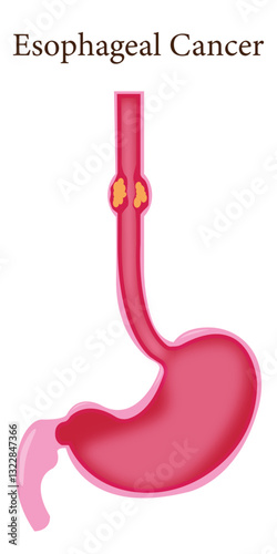 Medical illustration of esophageal cancer affecting the digestive system