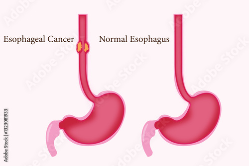 Healthcare infographic of esophageal cancer and normal esophagus
