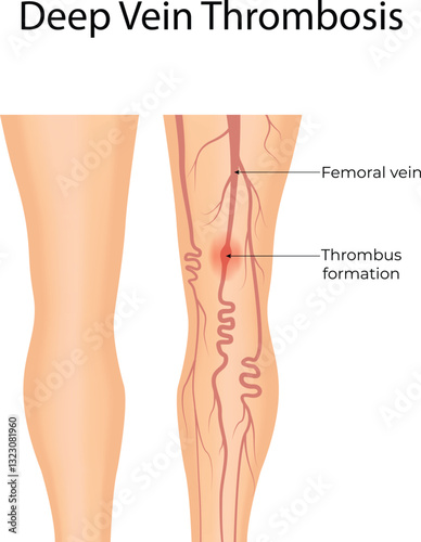 Illustration of Deep Vein Thrombosis DVT with thrombus formation in the leg Vector Illustration