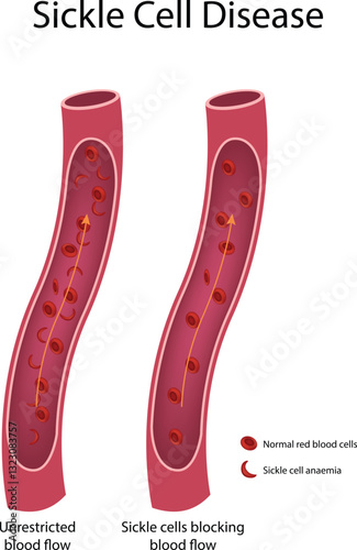 Sickle Cell Disease Normal vs Sickle Cell Anemia Blood Flow Vector Illustration
