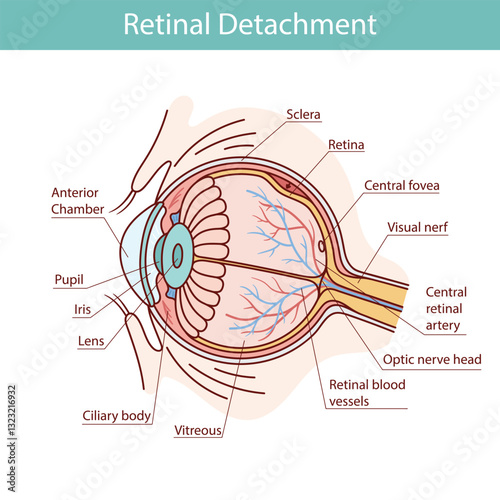 Retinal detachment vector diagram, anatomical diagram. vector cartoon style