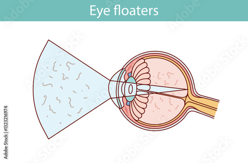Eye floaters. cartoon style vector illustration
