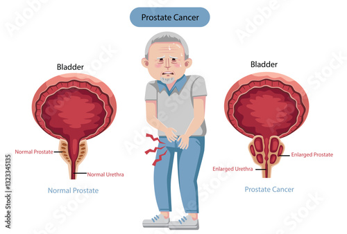 Male Reproductive System Anatomy and Normal Prostate and Prostate Cancer Inflammation