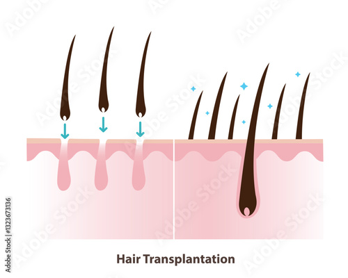 Before and after hair transplantation illustration. Permanent hair restoration, hair transplant surgery is procedure that moves hair follicles from a donor area to bald or thinning area of the scalp.