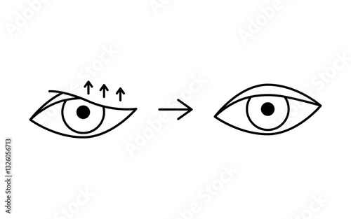 Drooping eyelid with correction, blepharoplasty line icon. Aesthetic plastic surgery of eye. Lift eyelid. Surgical facial rejuvenation. Vector illustration