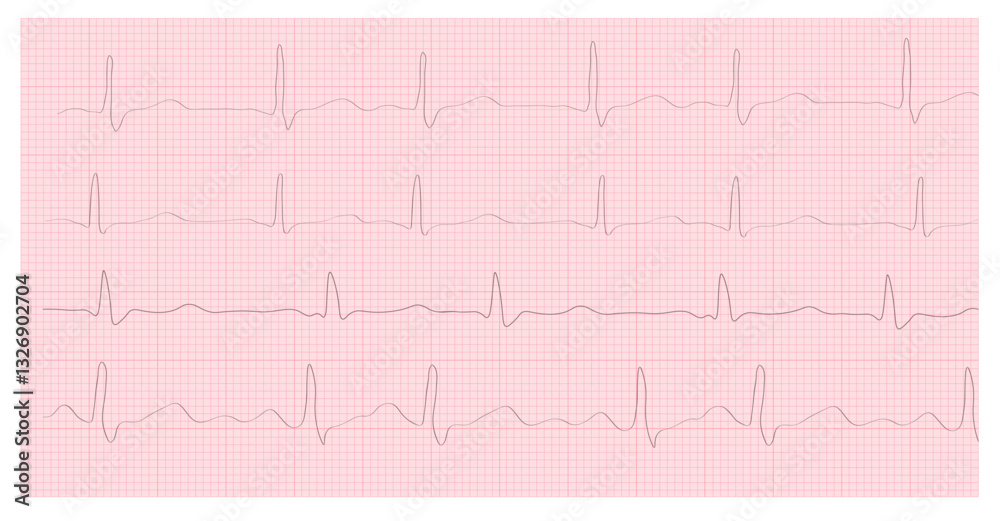 ECG Hyperkalemia. 8 Second ECG Paper. Electrocardiogram. Cardiogram. Heart beat. Heartbeat line. Electrocardiogram. Vector Stock Illustration. Isolated on white background. ECG Hyperkalemia. 8 Second ECG Paper. Electrocardiogram. Cardiogram. Heart beat. Heartbeat line. Electrocardiogram. Vector Stock Illustration. Isolated on white background.