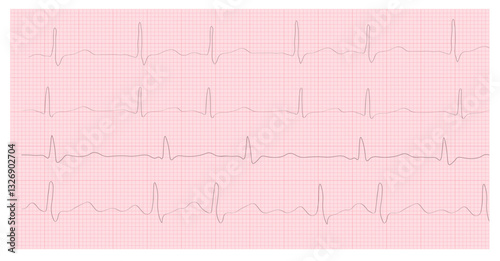 ECG Hyperkalemia. 8 Second ECG Paper. Electrocardiogram. Cardiogram. Heart beat. Heartbeat line. Electrocardiogram. Vector Stock Illustration. Isolated on white background. 
