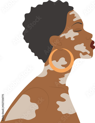 Afro-american woman illustration with vitiligo. World Vitiligo Day. Selfcare concept. Simple cartoon style