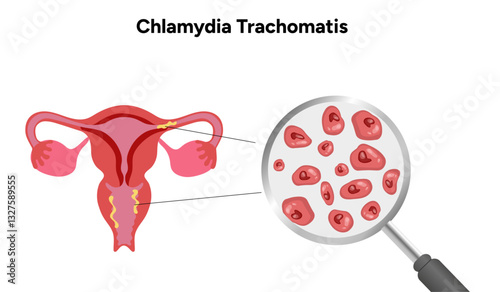 Chlamydia Trachomatis. Woman’s and man's reproductive system infections. Medical disease 