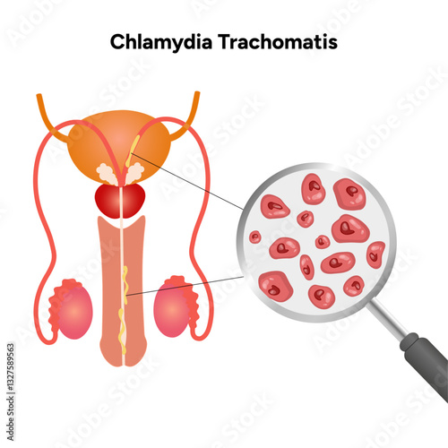 Chlamydia Trachomatis. Woman’s and man's reproductive system infections. Medical disease 