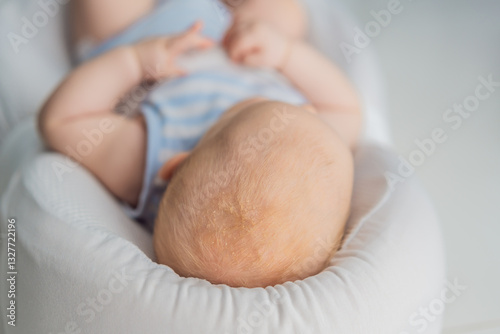 Close-up of a baby scalp showing cradle cap seborrheic dermatitis with dry, flaky patches. Common skin condition in newborns. Infant care, skincare, and health awareness concept