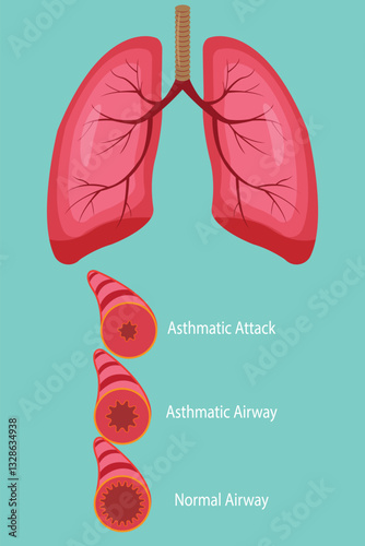 Medical illustration showing asthma airway and asthmatic attack