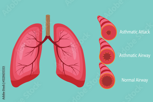 Asthma comparison of normal and inflamed airways in human lungs