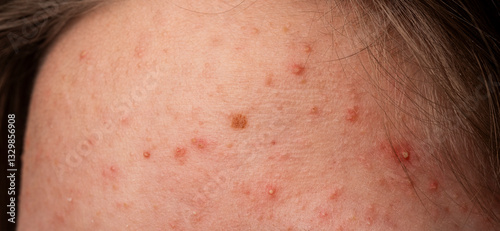 Skin acne background. Closeup acne pimple. Treatment for acne skin. Problem skincare. Pimples, acne, pores, scars. Natural skin. Skin care treatment. Pimples on face.