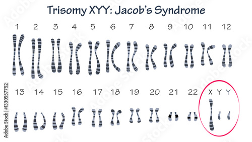 Jacob's syndrome trisomy 47 XYY genetic condition