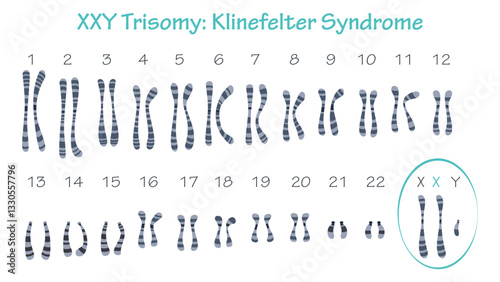 Klinefelter Syndrome XXY trisomy karyotype graphic
