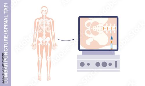 Lumbar puncture spinal tap