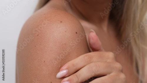 A young blonde woman scratches peeling sunburned skin on her shoulder with her nails, close-up. The image captures the texture of dry, damaged skin and the process of exfoliation after sun exposure