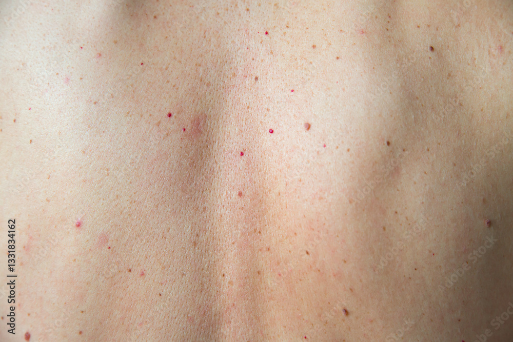 Fototapeta premium Close-up of a person's back with visible acne, freckles, and skin texture, highlighting natural imperfections and dermatological details