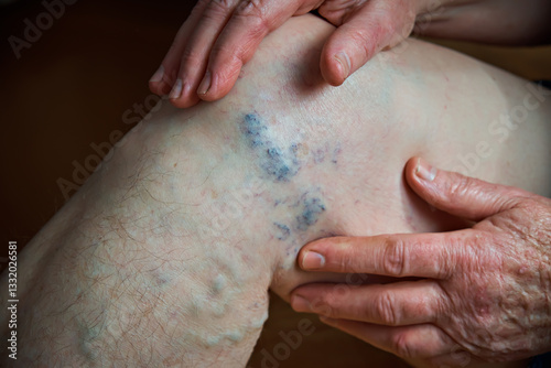 Elderly woman showing varicose veins on her leg close-up. Healthcare concept