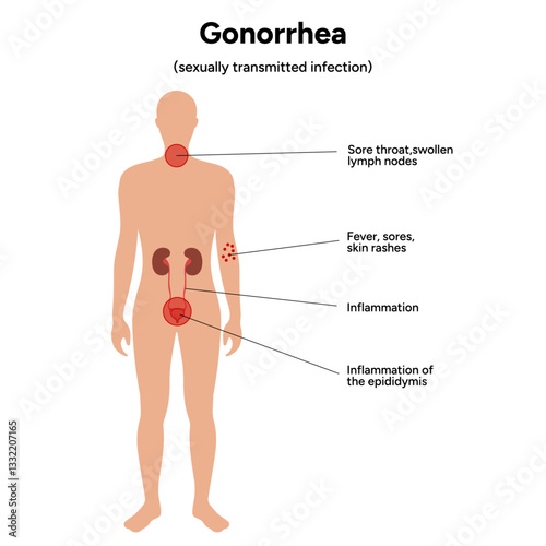 Gonorrhea. Human reproductive system transmitted infection virus bacterial. Medical diagram symptoms 