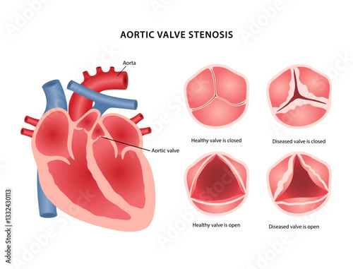 Aortic valve stenosis. Medical illustration of heart disease with image of heart show location of aortic valve, healthy and diseased valve in open and closed state. Vector illustration in flat style