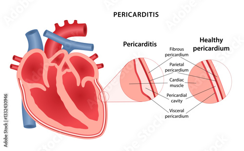 Pericarditis, inflammation of the lining of the heart. Medical illustration of human heart with an enlargement of the pathological area of ​​lining of heart. Vector illustration in flat style