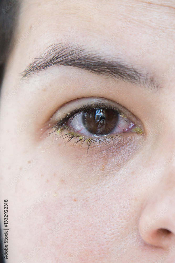 Obraz premium Close-up of an infected eye with redness and yellow discharge, symptoms of bacterial conjunctivitis, irritated and swollen look, medical condition, ophthalmology, eye health, vertical