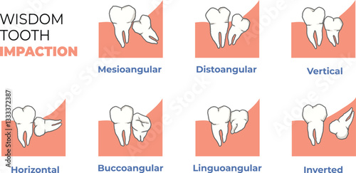 illustration of wisdom tooth impaction classifications
