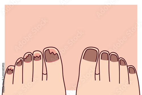 Another leg a pair of well-groomed feet with clean and healthy toenails. A concept of foot care, hygiene, and self-care. Toenails with a fungal infection, showing discoloration and damage. 