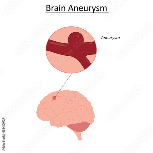 Brain aneurysm vector illustration