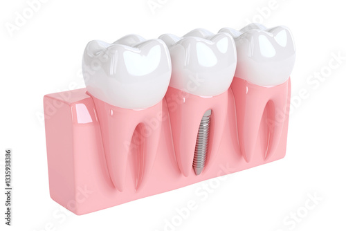 3D Render of Dental Implant and Natural Tooth on Transparent Background