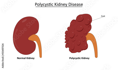 Polycystic kidney disease vector illustration
