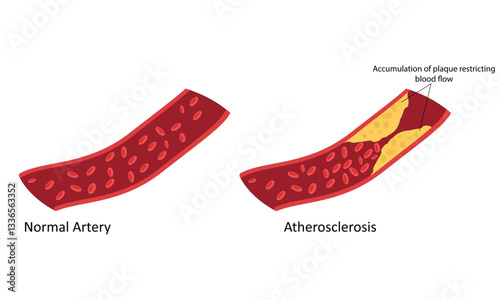 Atherosclerosis on artery vector illustration