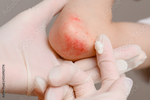 Dermatologist wearing gloves examines skin of sick patient suffering from attacks of allergies and contact dermatitis, eczema, scratching areas and applying healing ointment to affected areas.