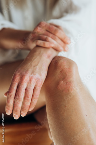 Sick person. Unrecognizable young woman suffering from autoimmune incurable dermatological skin disease called psoriasis. Large red inflamed scaly rash on elbows. joints affected by psoriatic arthriti