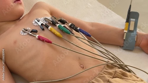 A young child is currently undergoing ECG monitoring with electrodes securely attached to their chest area