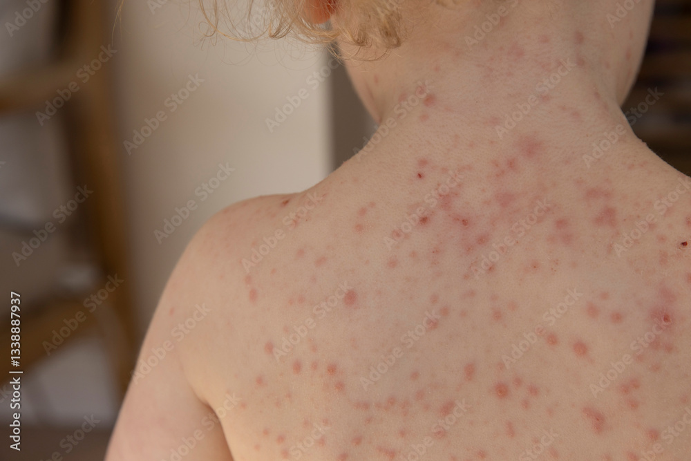 Fototapeta premium A young child with severe chicken pox illness covered in spots and blisters