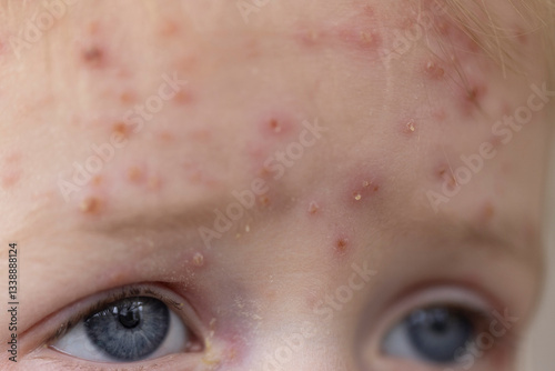 Fotografie A young child with severe chicken pox illness covered in spots and blisters