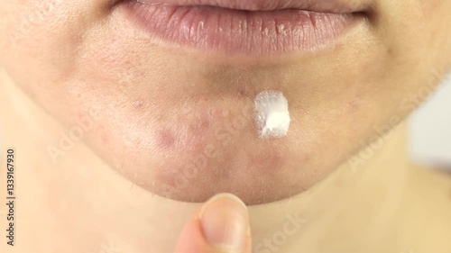 Close up, woman applying anti acne cream on her face. Face treatment procedure. 4k footage.