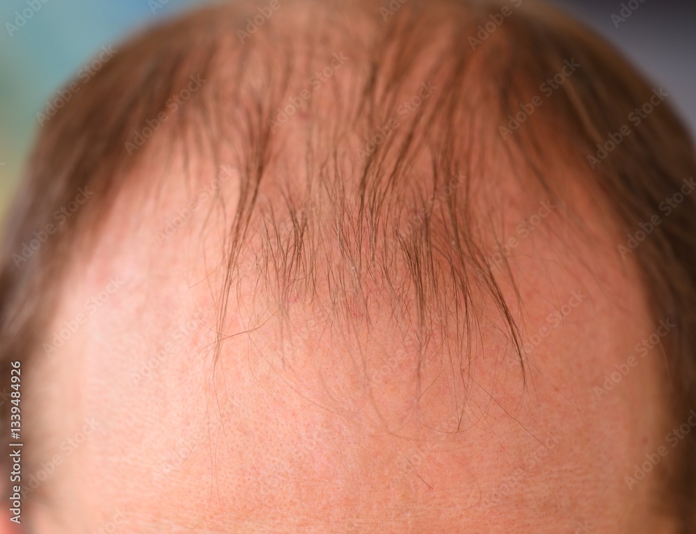 A close-up shot of man head with bald spots