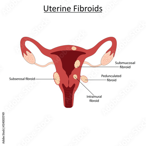 Uterine fibroids vector illustration
