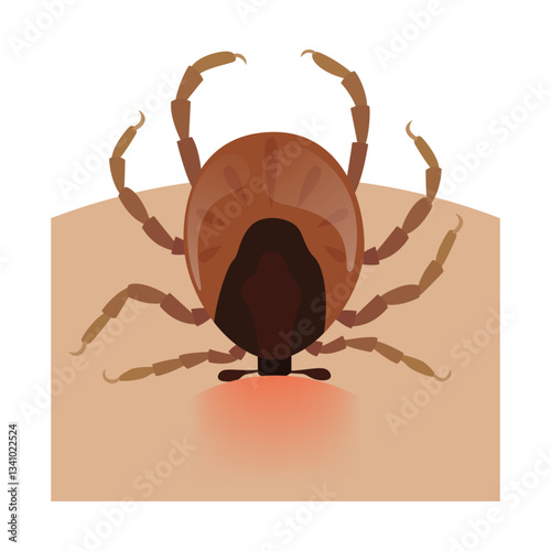 Encephalitis tick biting human skin causing lyme disease