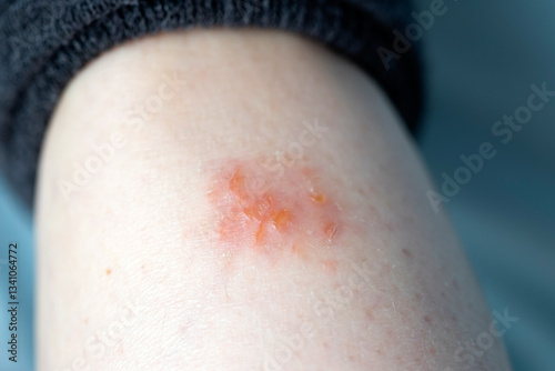 Close up on atopic dermatitis, eczema on leg.