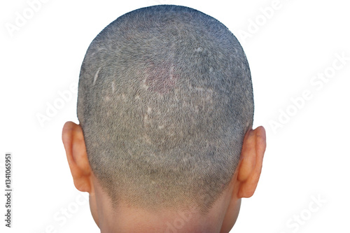 Rear view of bald head