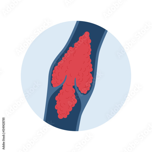 Deep vein thrombosis for healthcare infographic. Vector flat character illustration. Vascular disease diagnostic and treatment. Blood clot block vein in valve. Design for health care, education